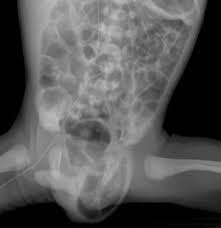 Image result for Inguinal hernia child