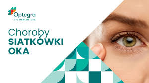 Zbudowane jest z soczewki ze zmienną i regulowaną ogniskową, tęczówki (przesłony) regulującej średnicę otworu (), przez którą wpada światło, oraz światłoczułej siatkówki w głębi oka. Choroby Siatkowki Oka Wszystko Co Powinienes Wiedziec Optegra Centrum Okulistyczne Youtube