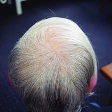 Tretinoin and other topical retinoids are used ideally before bed. Pdf Retinoids In Hair Disorders