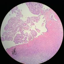 Differentiation of mesothelioma from adenocarcinoma. à¦Ÿ à¦‡à¦Ÿ à¦° Henry Yang Beautiful Case Of Well Differentiatiated Papillary Mesothelioma Of Ovary Calretinin Pax8 Wt1 Positive Berep4 Moc31 Negative Prominent Papillary Structures With Vascular Core And Single Layer Of Bland Cells No