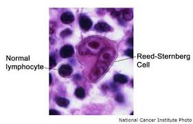 Understanding The Difference Between Hodgkin S And Non Hodgkin S Lymphoma Lymphoma Cancer Cell Hodgkins Lymphoma