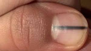 Adanya garis hitam yang muncul dijari nya, baik jari jempol atau jari lainnya, kemungkinan dapat disebabkan oleh adanya perdarahan ringan pada bawah kuku. Jika Ada Garis Hitam Di Kuku Anda Waspada Karena Bisa Jadi Itu Tanda Penyakit Ganas Tribun Jateng
