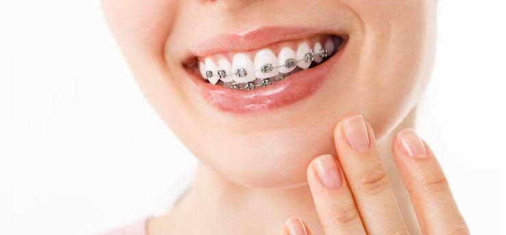 Metal Braces product image