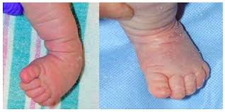 Image result for Clubfoot