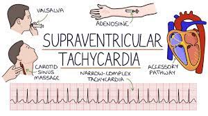 Svt® suite features three of the most renowned svt amp heads: Understanding Supraventricular Tachycardia Svt Youtube