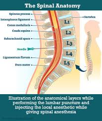 Image result for Intrapleural Anesthesia