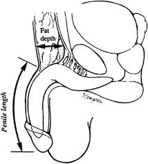 This article is more than 6 years old. Penile Size And Penile Enlargement Surgery A Review International Journal Of Impotence Research