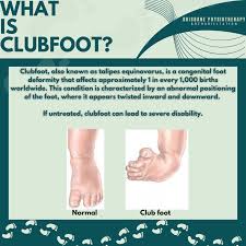 Image result for Clubfoot