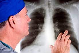 How Lung Cancer Is Diagnosed