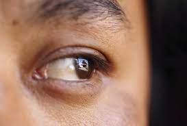 This is a rare cancer and there is not much known about the possible cause. What Is Ocular Melanoma Doctors Find Extremely Rare Eye Cancer In Groups Across Two States