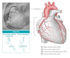 Coronary Artery Disease Amboss