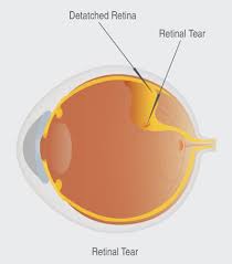 Talk with your doctor about the risks and benefits of vitrectomy. Retinal Detachment Dc Retinal Tears Treatment Weps