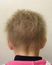 Putting short hair in an updo how to make short hair appear as longer updo? Disorders Of Hair And Nail Springerlink