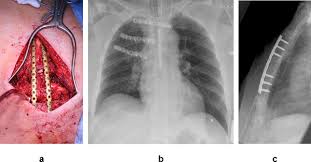 Image result for Sternal Fracture
