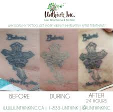 Caring for tattoos after laser removal means boosting your body's overall health. Tattoo Look Darker Post Tattoo Removal Treatment Unthink Inc