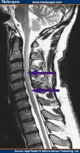 Are just guidelines for the provision of specialty health services. Cervical Spine Mri Mri Spines Cervical