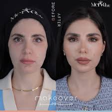 فيلر تعبئة الخفسات و رفع المؤخرة و زيادة الحجم بشكل جميل و طبيعي اذا كنتو  تعانون من الخفسات فيلر الجسم حل امن و يعطيكم شكل انثوي جميل و كونتور جذاب  الجسم بدون