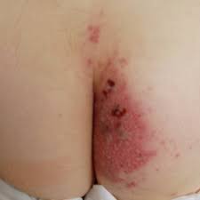 Tatal meu are zona zoster dar eu si mama mea am avut cu ani in urma varicela e posibil sa luam si noi zona. Pdf A Case Of Acute Urinary Retention After Cesarean Section Caused By Herpes Zoster Infection