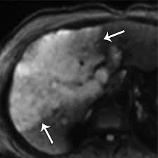 Y también este libro fue escrito por un escritor de libros que se considera popular hoy en. Multimodality Imaging Of Abdominopelvic Tumors With Venous Invasion Radiographics