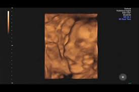 I got lots of pictures and a 30 minute video in 3d. 4d Ultrasound Study Of Fetal Facial Expressions At 20 24 Weeks Of Gestation Sciencedirect