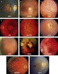 We did not find results for: Leber Congenital Amaurosis Genes Proteins And Disease Mechanisms Sciencedirect