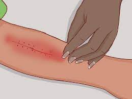 As always, it's best to let a professional provider do this. How To Remove Surgical Staples 8 Steps With Pictures Wikihow