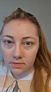 Day 2 of a major migraine and dizziness.( I've been dizzy for months now).  It hurts in the middle of the back of my head through to my right eye.  Which it