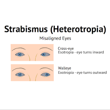 Image result for Strabismus