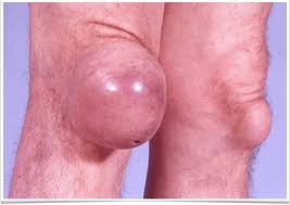 Image result for gout symptoms knee