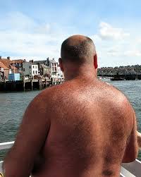 Image result for Hypertrichosis