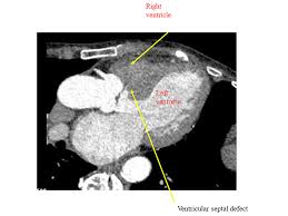 Image result for Ventricular Septal Defect