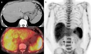 Check spelling or type a new query. Fdg Pet Ct Imaging Findings Of Hepatic Tumors And Tumor Like Lesions Based On Molecular Background Springerlink