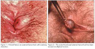 When a thrombosed hemorrhoid becomes too full of. Anorectal Complaints Office Diagnosis And Treatment Part 1 Consultant360