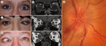 Graves' disease is an immune system disorder that results in the overproduction of thyroid hormones (hyperthyroidism). Graves Disease Nature Reviews Disease Primers