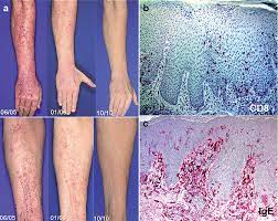 We did not find results for: Long Term Treatment Of Severe Recalcitrant Atopic Dermatitis With Omalizumab An Anti Immuno Globulin E Html Acta Dermato Venereologica