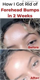 How I Got Rid Of Forehead Bumps In 2 Weeks Acnetreatment Fungalacne Skincare Forehead Bumps Skin Bumps Forehead Acne