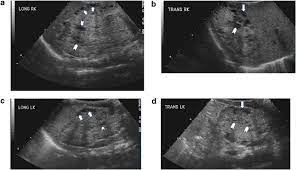 Neonatal Autosomal Recessive Polycystic Kidney Disease Journal Of Perinatology