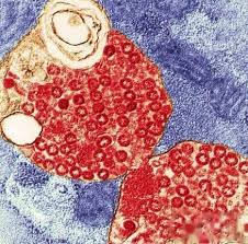 天花（英語： smallpox ）是一種由天花病毒引起之人類傳染病。 患者一般在染病後的12天內，出現包括發燒、肌肉疼痛、頭痛等近似普通感冒的症狀。 幾天後，其口 咽部分的黏膜會長出紅點，身體多處地方亦會長出皮疹（以臉部居多）。 天花病毒共有兩類：主天花病毒及次天花病毒。根據患者的. ä¸–ç•Œä¸Šæœ€è‡´å'½çš„ç—…æ¯'å'Œç»†èŒ å¤©èŠ±ç—…æ¯' åŽ†å²è¶£é—»ç½'
