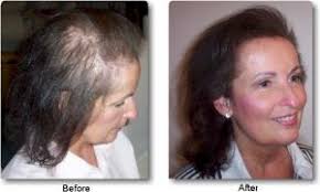 Haarsystem