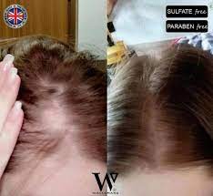 The ingredients are designed to naturally block excess dht production in your body a key cause of hair loss. Shoppers Rave Over 23 Hair Growth Shampoo And Conditioner Which Claims To Rid Users Of Bald Patches And Thinning Hair