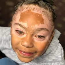 National Vitiligo Bond Inc Foundation
