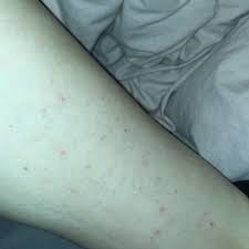 Sie können nicht dauerhaft in deinem bett überleben. Milben Flohe Oder Einfach Gereizte Haut Gesundheit Und Medizin Allergie Bett