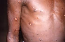 These are the symptoms of monkeypox and how to treat them - ABC News