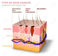 Breast cancer is the second most common cancer found in women — after skin cancer — but that doesn't mean men aren't at risk as well. Skin Tumors Moles And Spots 3d Section Of The Skin Layer Three Types Of Skin Cancer Squamous Cell Carcinoma Basal Cell Carcinoma Melanoma 3d Render Stock Photo Picture And Royalty Free Image