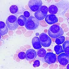 Multiple myeloma occurs in older dogs, and is not particularly associated with either males or females. Israel Gives New Hope To Patients With Multiple Myeloma Israel Cancer Research Fund