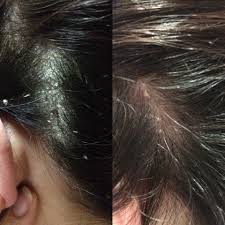 It typically presents as small white flakes. Help Scalp Psoriasis With Monat S Rejuvenique Oil Clear Scalp And Beautiful Hair All At The Same Thick Hair Remedies Psoriasis Hair Scalp Psoriasis Treatment