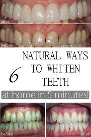When your pearly whites aren't so pearly white, it can be frustrating. Pin On Health Tips