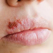 Herpes simplex i löst das lippenherpes aus, herpes simplex ii ist für genitalherpes verantwortlich. Was Hilft Gegen Herpes Antwort Auf Brennende Fragen Geo