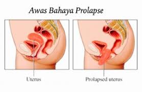 Bagi mereka yang mempunyai masalah rahim jatuh yang ringan, anda mungkin tidak akan mengalami sebarang. Rahim Jatuh Archives Ila Hassan
