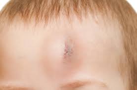 Image result for sores on the head in children